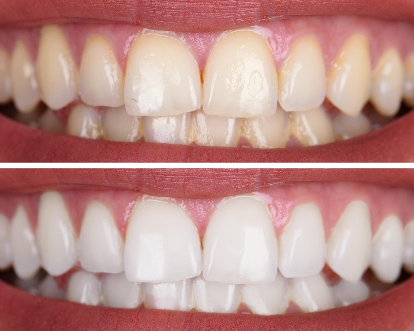 tooth whitenig – Picasso Dental Studio tooth whitenig - Picasso Dental Studio